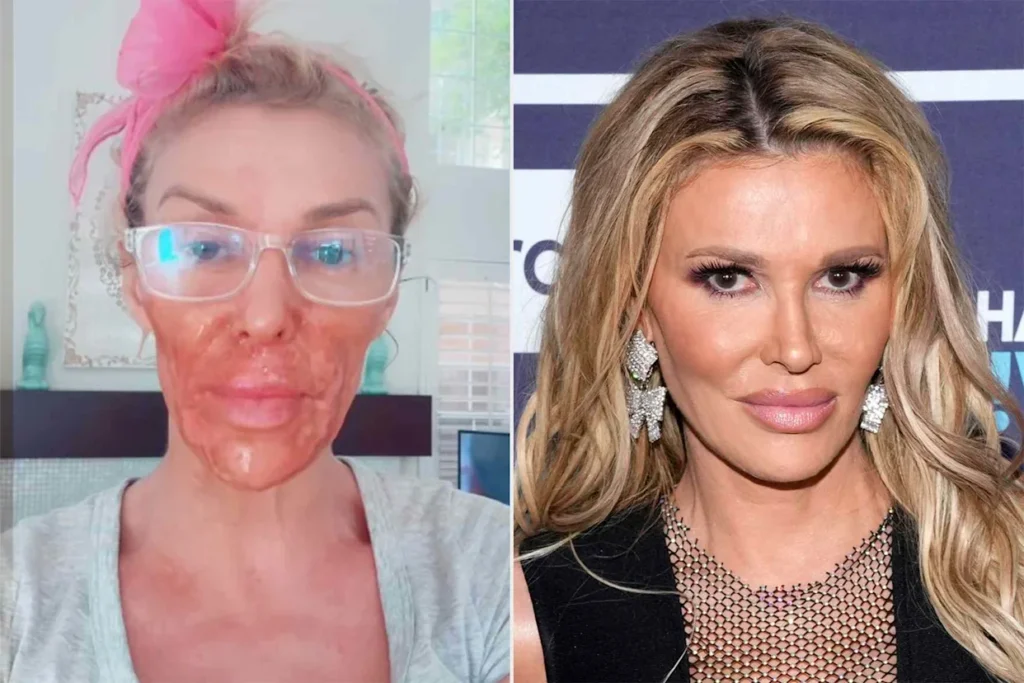 Brandi Glanville suffers chemical burns after using Nair to kill facial parasite