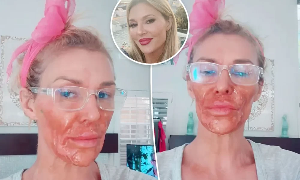 Brandi Glanville suffers chemical burns after using Nair to kill facial parasite