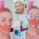 Brandi Glanville suffers chemical burns after using Nair to kill facial parasite