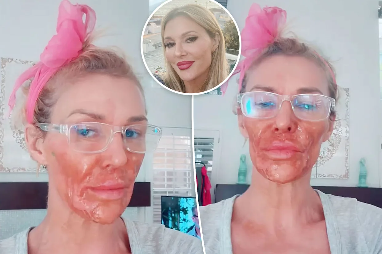Brandi Glanville suffers chemical burns after using Nair to kill facial parasite