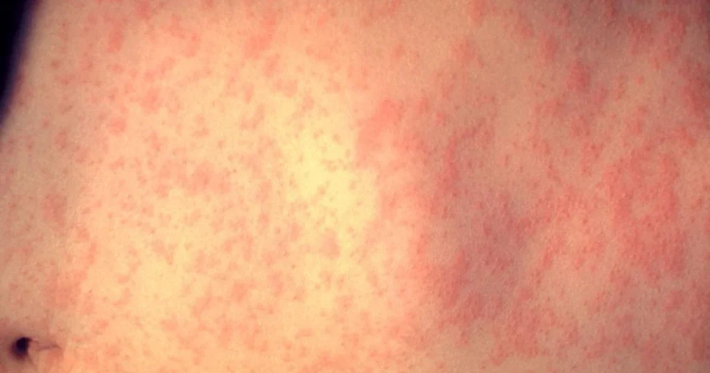Measles Alert in Brisbane and Sunshine Coast as Traveller Tests Positive