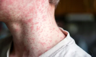 Measles Alert in Brisbane and Sunshine Coast as Traveller Tests Positive