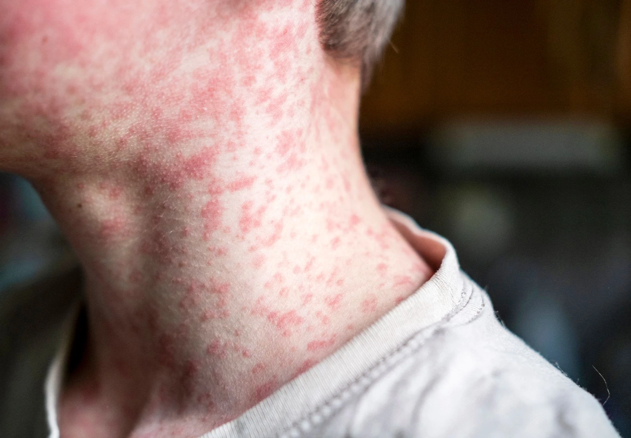 Measles Alert in Brisbane and Sunshine Coast as Traveller Tests Positive